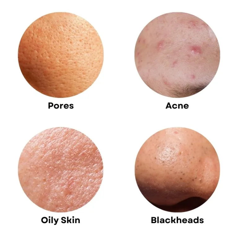 What Can Carbon Peel Laser Treat