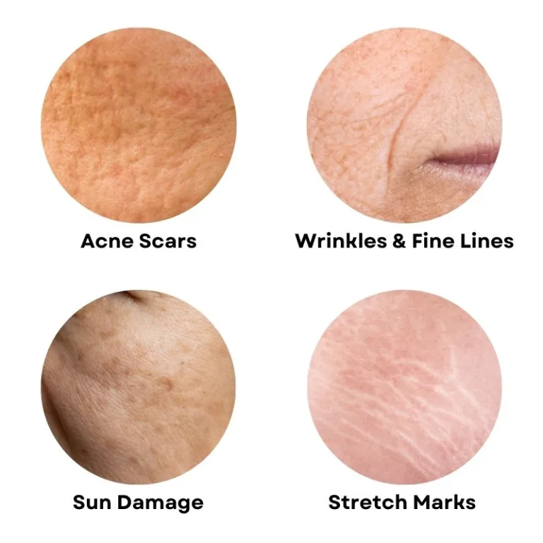 What Can Fractional CO2 Laser Treat