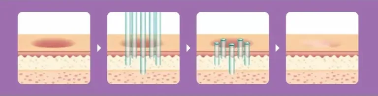 Fractional CO2 Laser Works